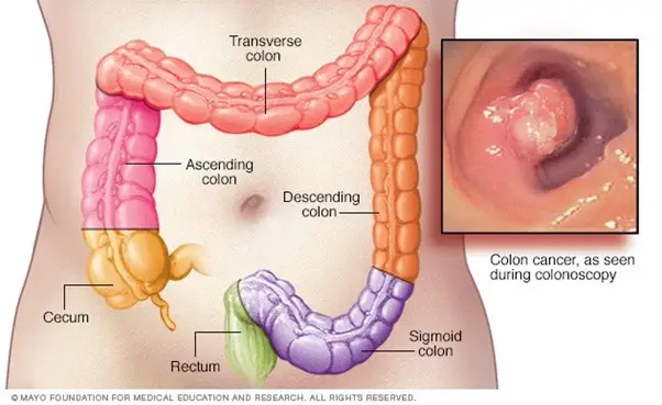Illustration of a human colon and image of colon cancer